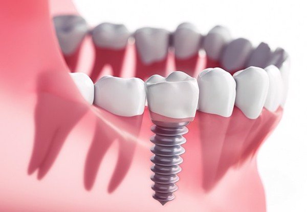 Trồng Răng Implant – Giải Pháp Trồng Răng Hoàn Hảo