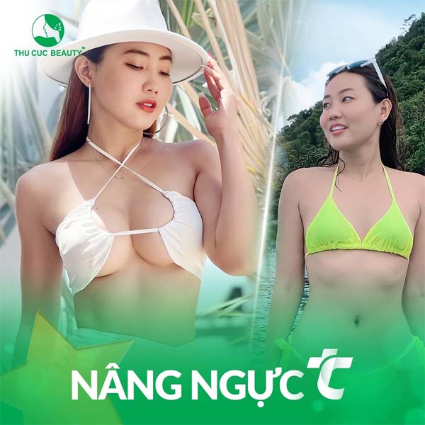 Nâng ngực có được vĩnh viễn không?