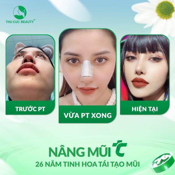 Nâng mũi