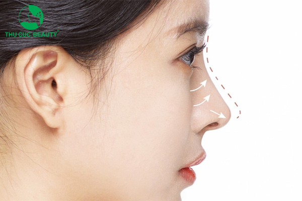 Nâng mũi implant và những điều cần biết