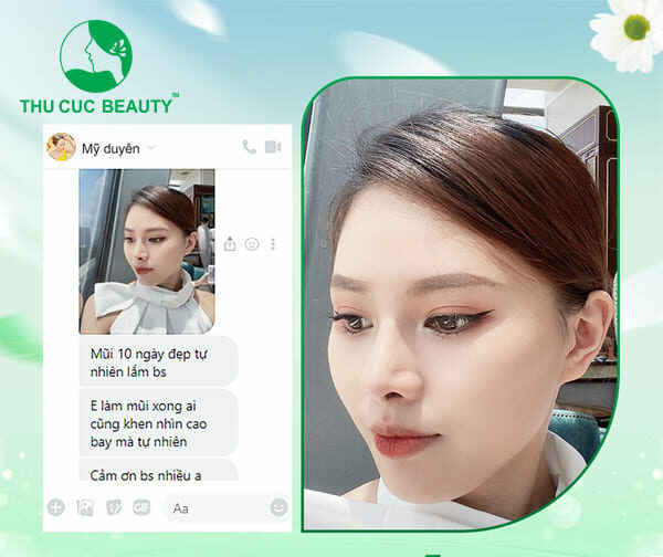 Nâng mũi sau 10 ngày