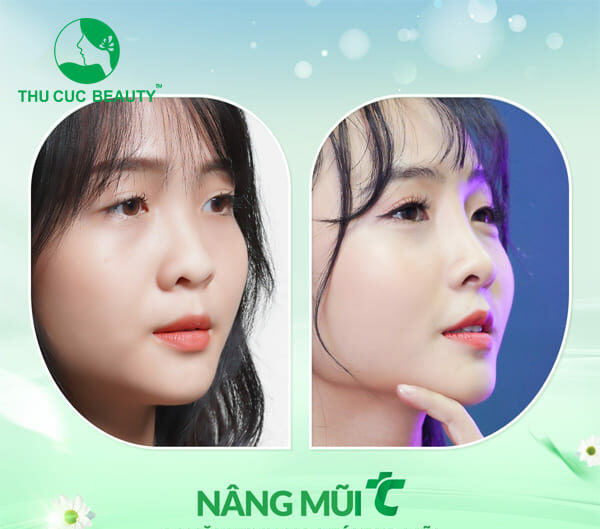 nâng mũi sụn nhân tạo có vĩnh viễn không