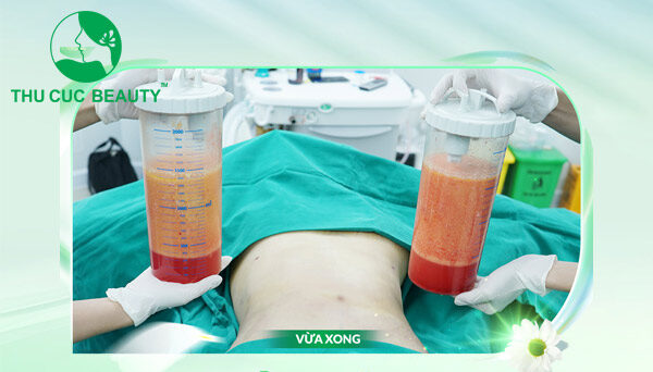Hút mỡ mang tới vóc dáng thon gọn, cân đối