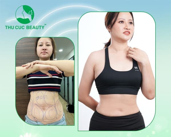hình ảnh trước và sau hút mỡ