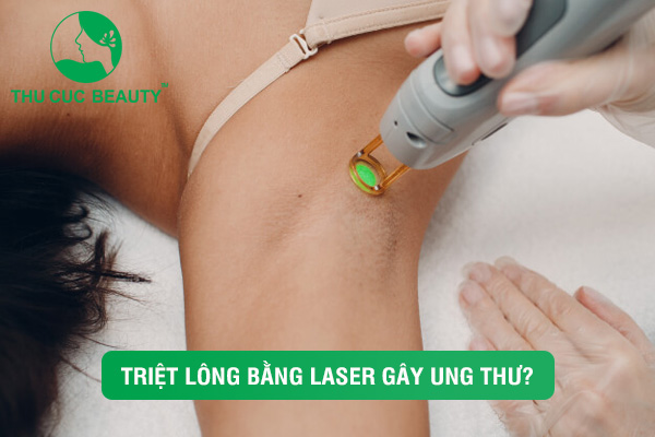 Triệt lông bằng laser gây ung thư có đúng thật không?