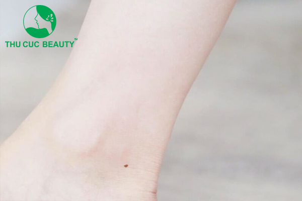 nốt ruồi ở cổ chân