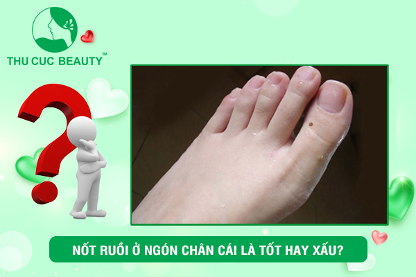nốt ruồi ở ngón chân cái là đảm bảo chất lượng hoặc xấu