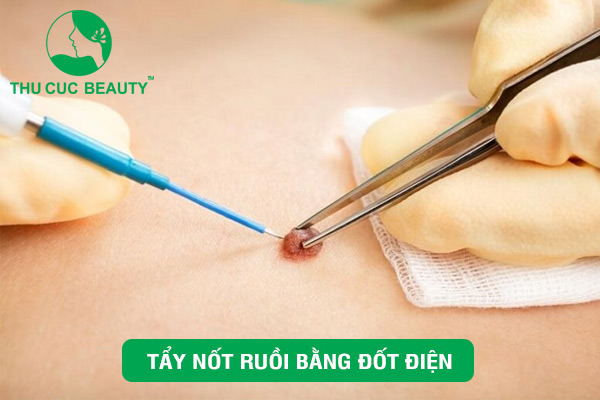 Tẩy nốt ruồi bằng đốt điện