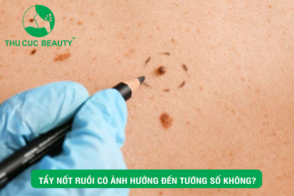 Tẩy nốt ruồi có ảnh hưởng đến tướng số không?