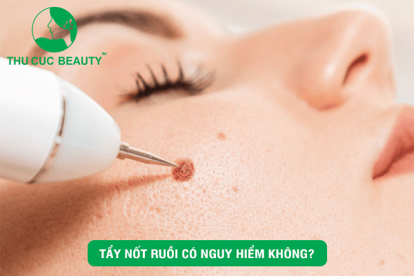 Tẩy nốt ruồi có nguy hiểm không?