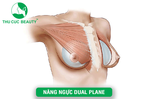 Nâng ngực Dual Plane – Giải pháp làm đẹp hiệu quả