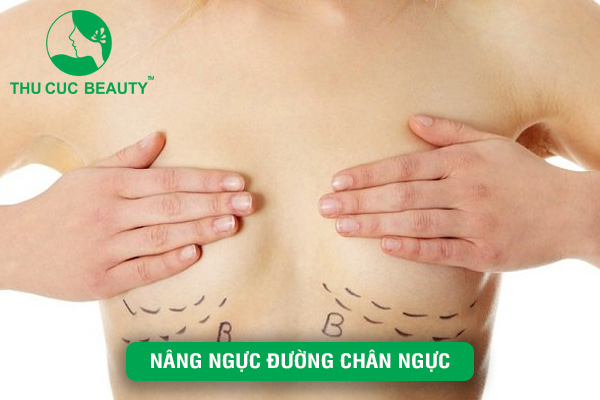 Nâng ngực đường chân ngực