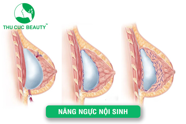 Nâng ngực nội sinh