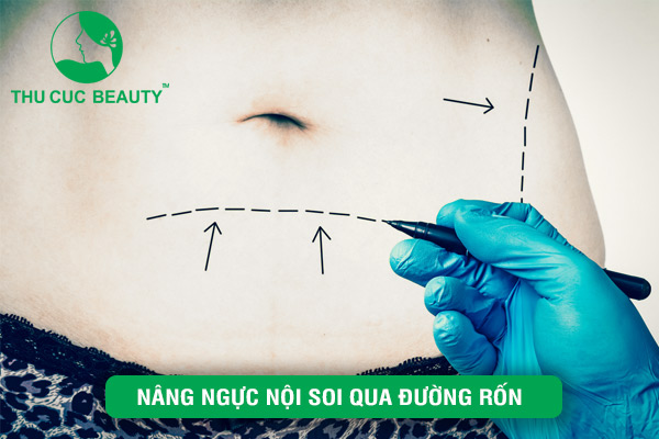 Nâng ngực nội soi qua đường rốn