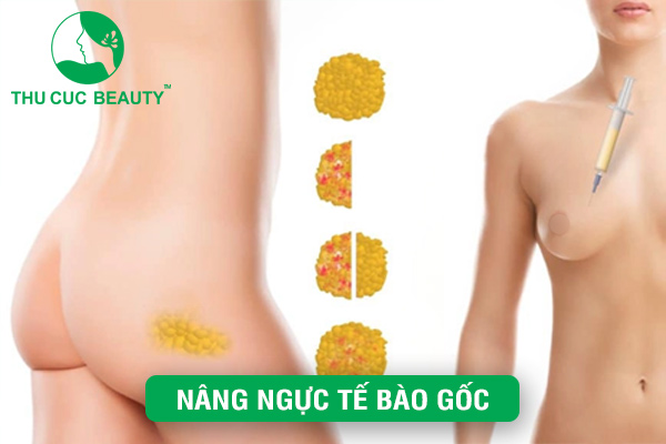 Nâng ngực tế bào gốc