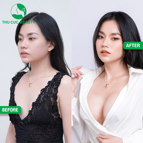 trước và sau khi nâng ngực tại Thu Cúc Sài Gòn