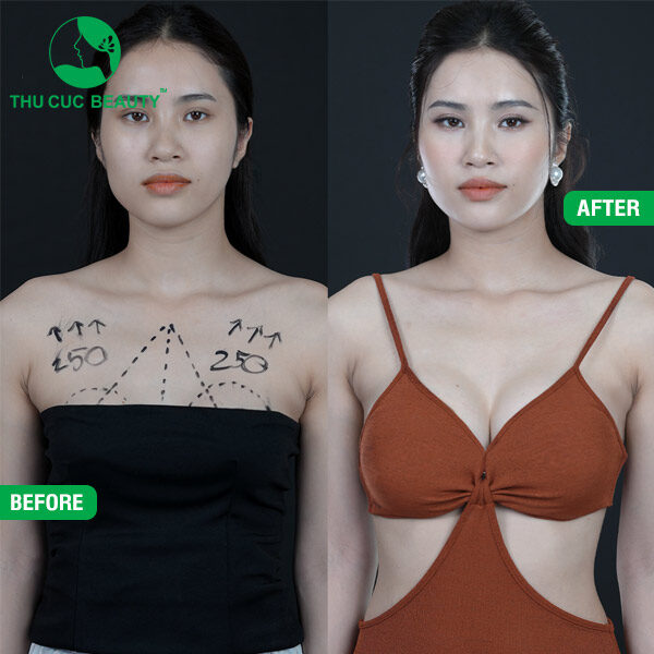 trước và sau khi nâng ngực tại Thu Cúc Sài Gòn