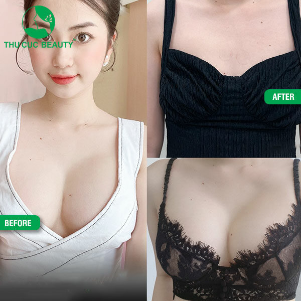 trước và sau khi sửa ngực lại Thu Cúc Sài Gòn