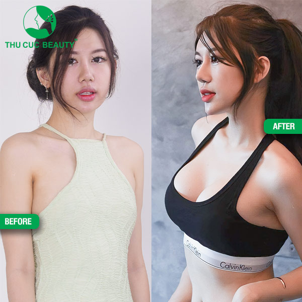 trước và sau nâng ngực túi Motiva