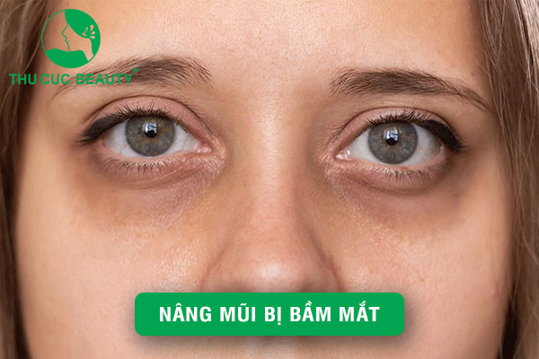 Cách xử lý tình trạng nâng mũi bị bầm mắt hiệu quả