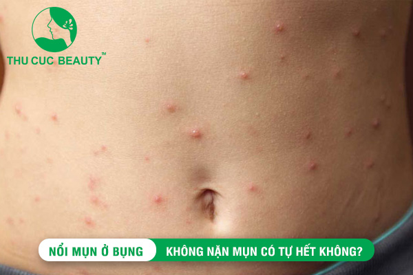 Nổi mụn ở bụng và những điều cần biết