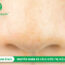 Mụn cám ở mũi: Nguyên nhân và cách điều trị hiệu quả