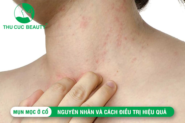 Mụn mọc ở cổ: Nguyên nhân và cách điều trị hiệu quả