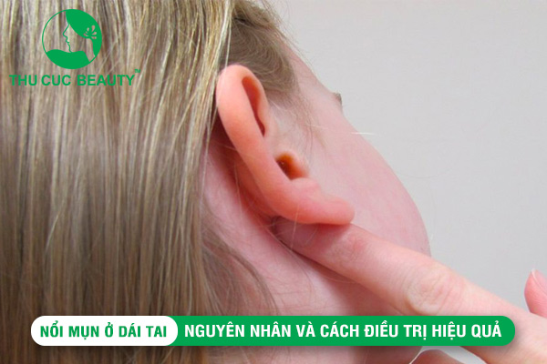 Nổi mụn ở dái tai: Nguyên nhân và cách điều trị hiệu quả