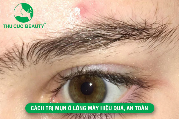 Cách trị mụn ở lông mày hiệu quả