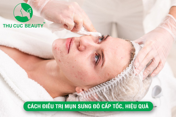 Cách điều trị mụn sưng đỏ cấp tốc, hiệu quả