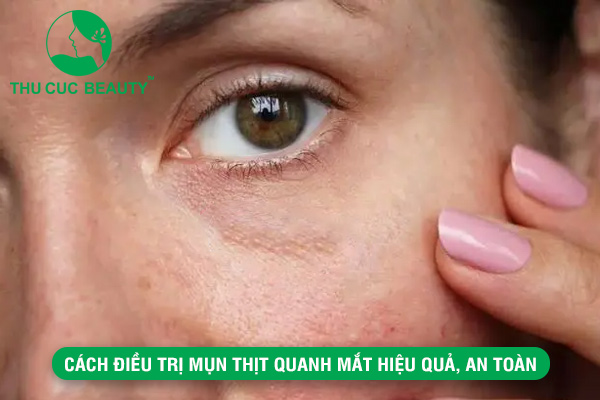 Cách điều trị mụn thịt quanh mắt hiệu quả,