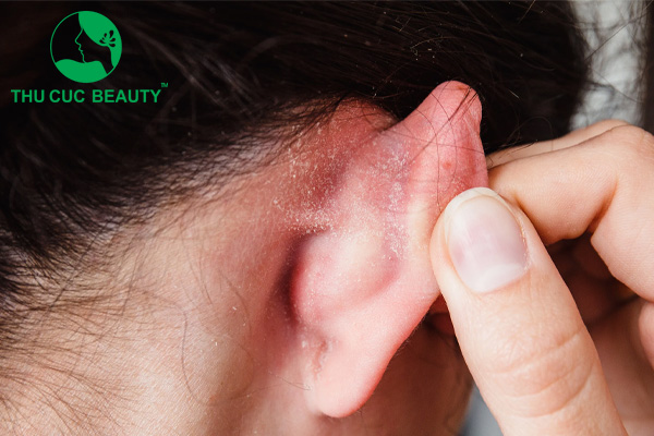 Nổi mụn ở mang tai là cảnh báo của bệnh gì