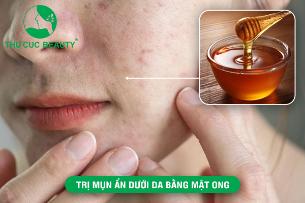 Những cách trị mụn ẩn dưới da bằng mật ong hiệu quả