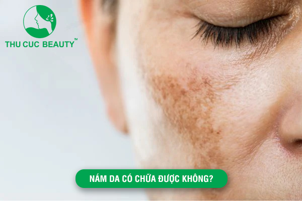 Nám da có chữa được không?